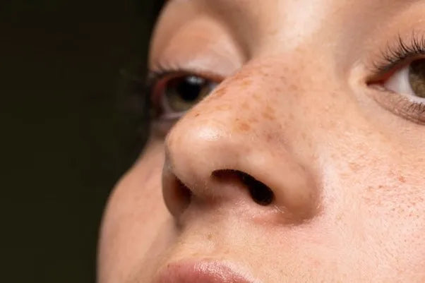 How to reduce dark spots on face